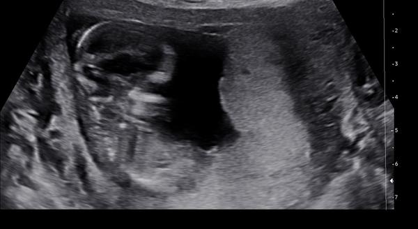 Dokáže lékař odhadnout pohlaví v 13. týdnu?