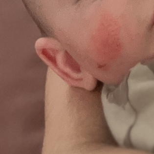 Co způsobuje suché červené fleky na tváři kojence?