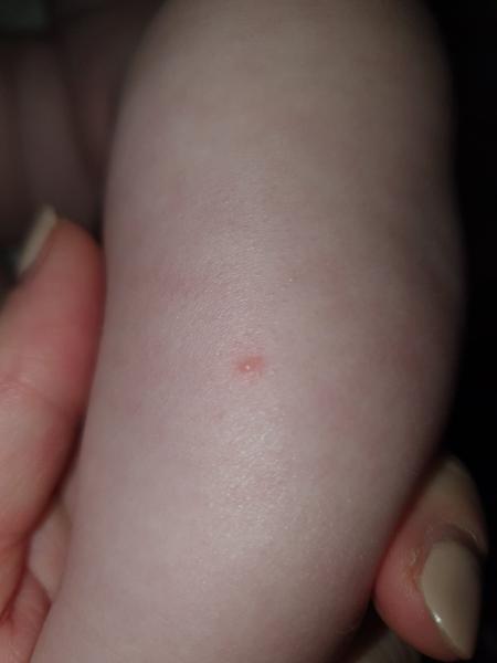 Má dcera pouze jediný neštovicový pupínek?