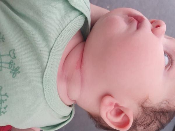 Červený flek pod krkem. Co to je a co s tím?