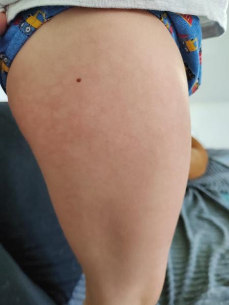 Pátá nemoc - vyrážka trvá měsíc. Jaký na to máte názor a jak pomoci, aby vyrážka zmizela?