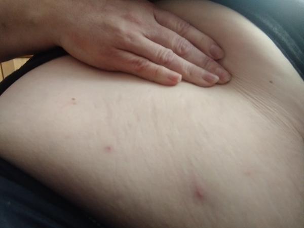 Vyrážka na břiše. Co to může být?