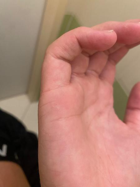 Je to svrab? Jak rozpoznat svrab a co s ním dělat?