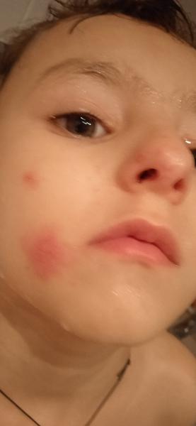 Ekzém nebo kvasinka?