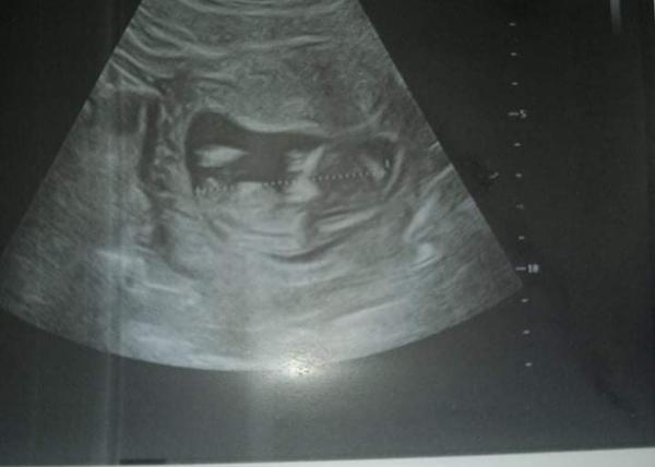 Pohlaví na ultrazvuku. Co myslíte, že je to?