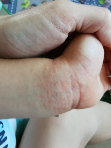 Rychle se šířící vyrážka u dětí. Jak řešit?