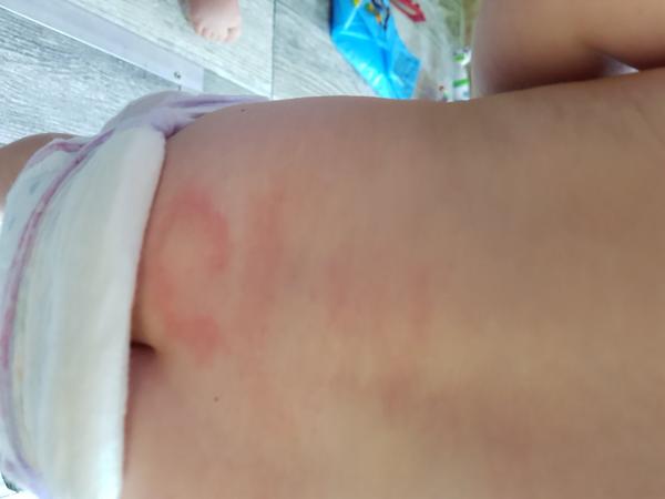 Vyrážka. Co by to mohlo být?