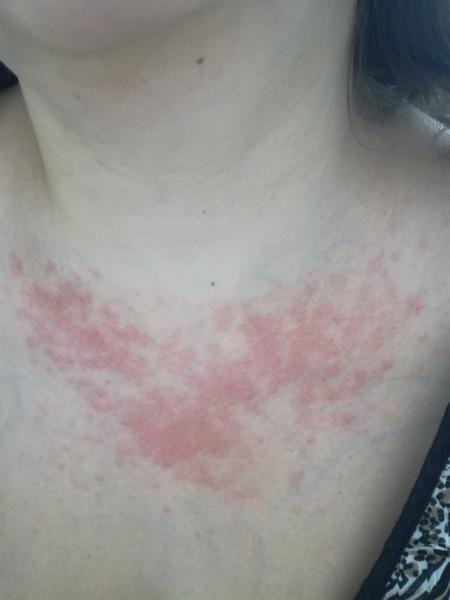 Podrážděná kůže po kojení. Co způsobuje vyrážku?