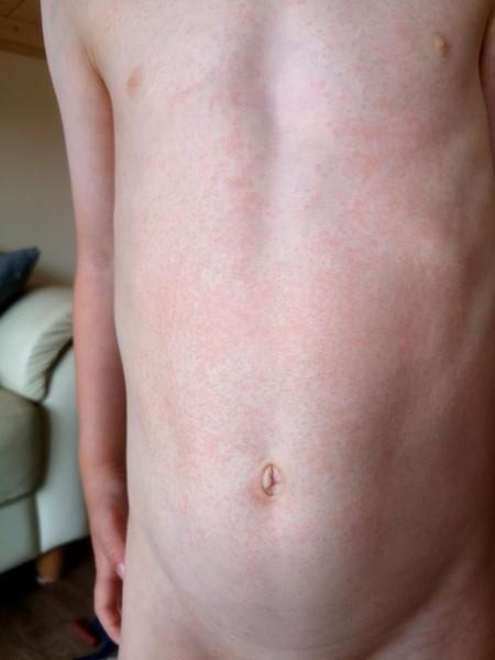 Vyrážka bez teplot. Mohlo by se jednat o potravinovou alergii?