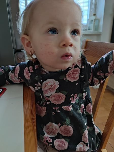 Má omikron u dětí vyrážku? Jak ji léčit?