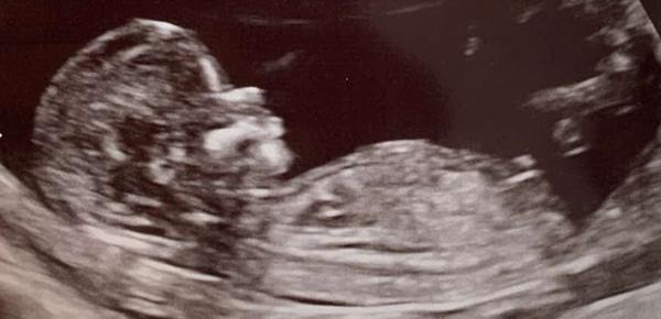 Lze určit pohlaví dítěte?