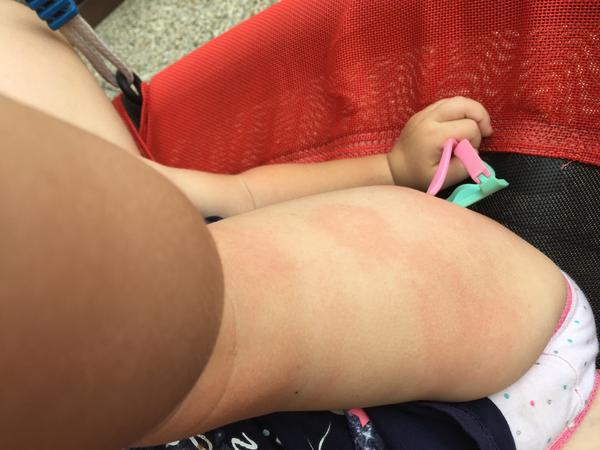 Fleky na noze. Mohla by to být borelióza? Nebo spíše alergie?