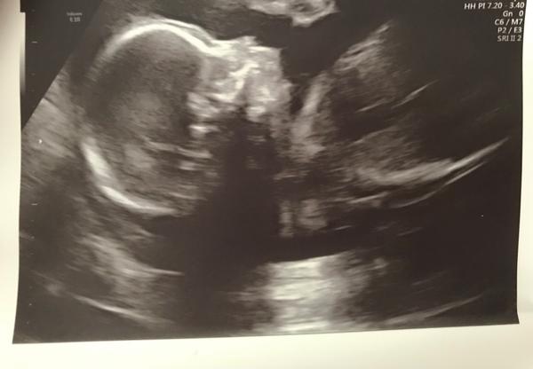 Malá nebo ustupující brada na utz...