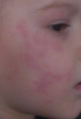 Výražka v obličeji, máte zkušenost?