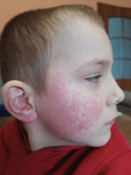 Co způsobuje vyrážku? Jak ji správně léčit?