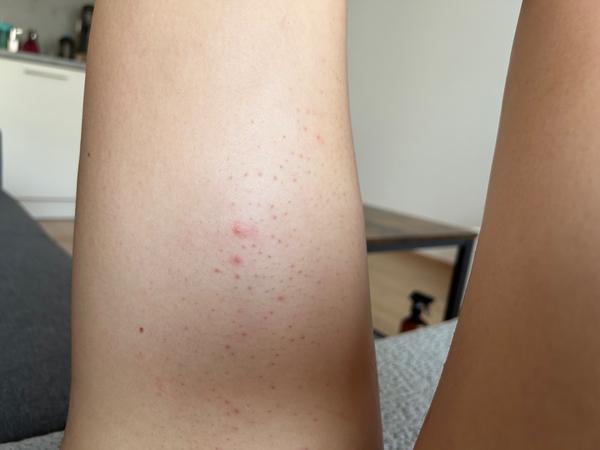 Jak se zbavit opruzenin po holení v létě?