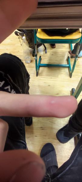 Bolestivé pupínky na ruce. Jaká je možná příčina?