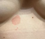 Zvětšení fleku na kůži pod prsy. Co to může být?