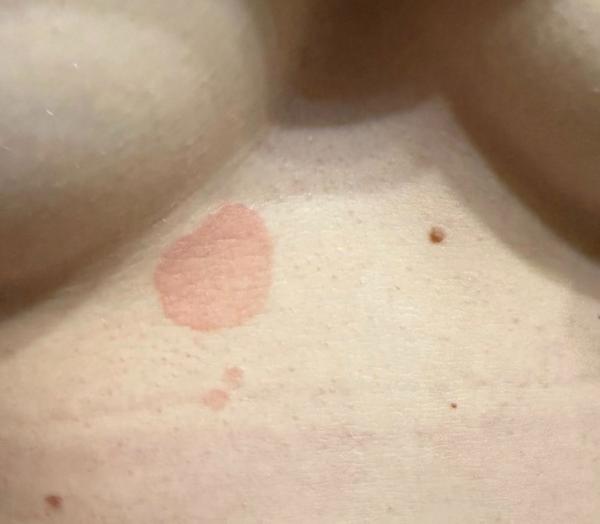 Zvětšení fleku na kůži pod prsy. Co to může být?