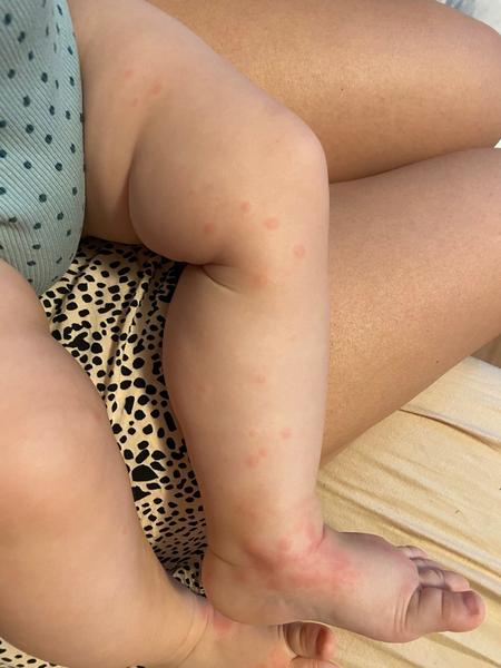 Vyrážka. Co myslíte?