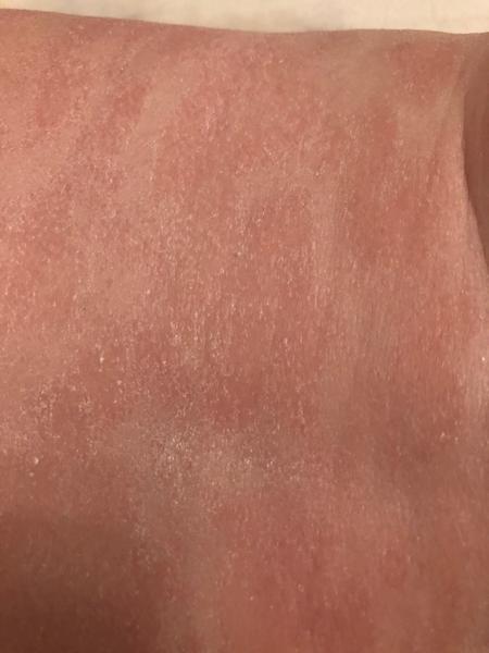 Ekzém nebo kvasinka. Jak a čím pokračovat v léčbě?