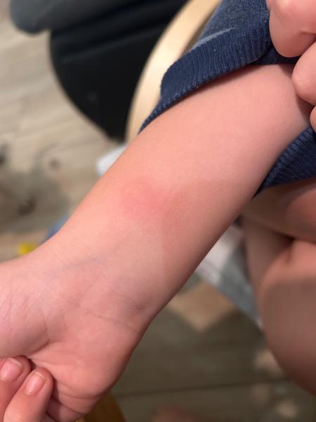 Štípance na těle – jsou to štěnice?