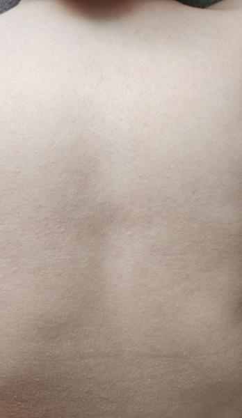 Krupičková vyrážka u dítěte. Mohla by to být alergie?