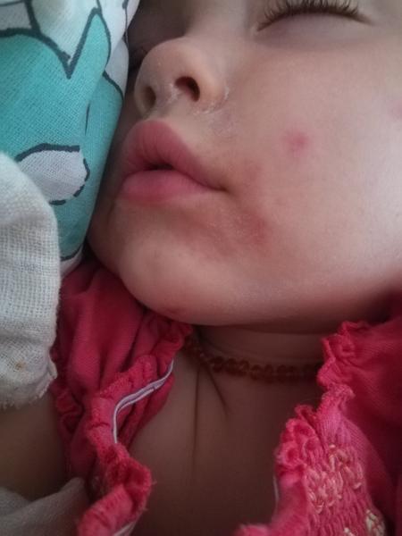 Atopický ekzém? Kvasinky? Co by to mohlo být?