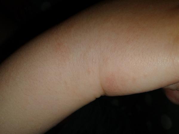 Vyrážka-týden. Co myslíte?