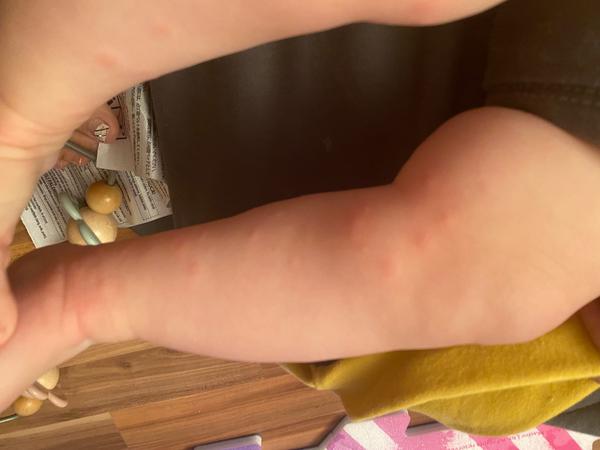 Vyrážka. Co myslíte?