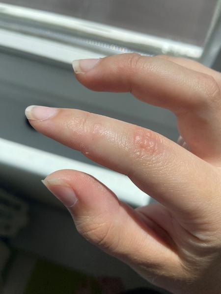 Jak řešit svědivé pupínky na prstech ruky?