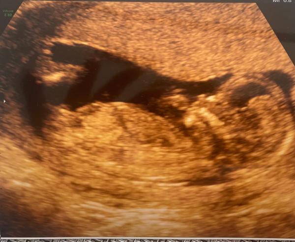 Rozlišení pohlaví miminka na prvním screeningu: Jak na to?