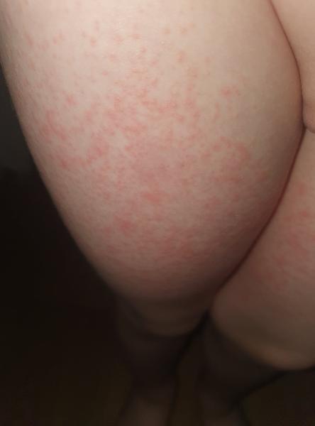 Pupínky u čtyřletého dítěte. Co to může být?