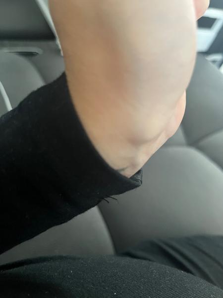 Boulička na zápěstí: Je to ganglion? Kam se vydat?