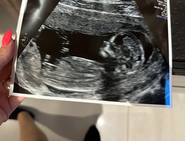 Pohlaví - 1. screening. Je vidět?