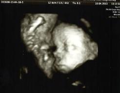 Edwardsův syndrom a jeho odhalení pomocí screeningu Edwardsův syndrom a jeho odhalení pomocí screeningu