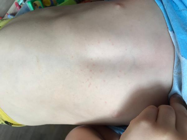 Vyrážka. Co by to mohlo být? 