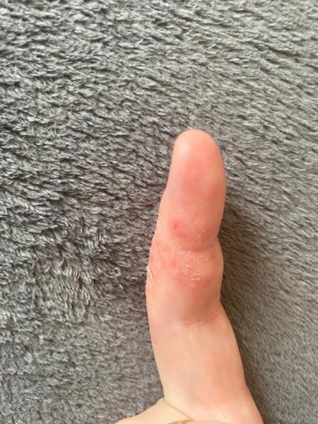 Může suchá kůže s puchýřky znamenat vyrážku?