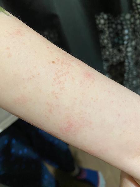 Červené flíčky po těle. Nesvědí, nebolí. Co by to mohlo být?