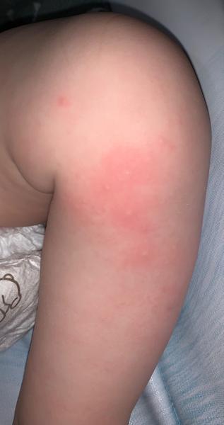 Zkušenost s vyrážkou na nohou u kojenců?