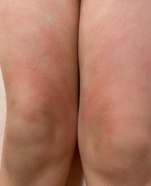 Je to atopický ekzém, nebo něco jiného? Zkušenosti rodičů