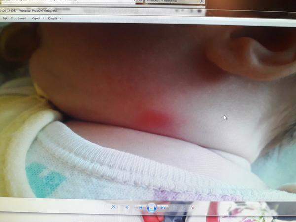 Flíček na kůži po zlatém stafylokokovi