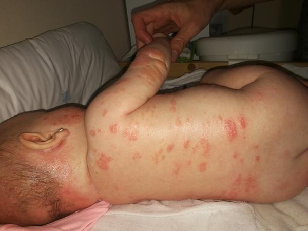 Rozsáhlý ekzém. Pomůžete, prosím?