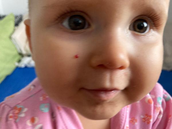 Krvavý výrůstek na tváři dcery. Co by to mohlo být?