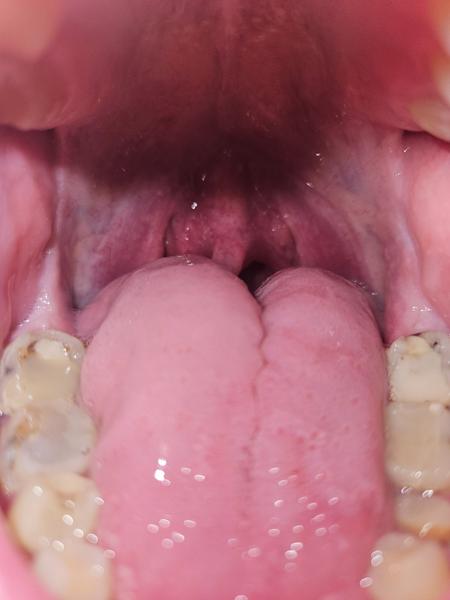 Co způsobuje bolest v krku při polykání?