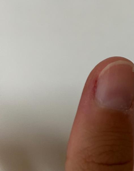 Co dělat se zraněným nehtem na palci ruky?