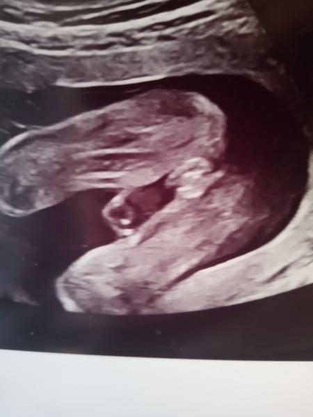 Pohlaví miminka ve 21. týdnu: Poradíte s tipem?