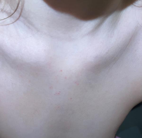 Možné příčiny svědivé vyrážky u dětí?