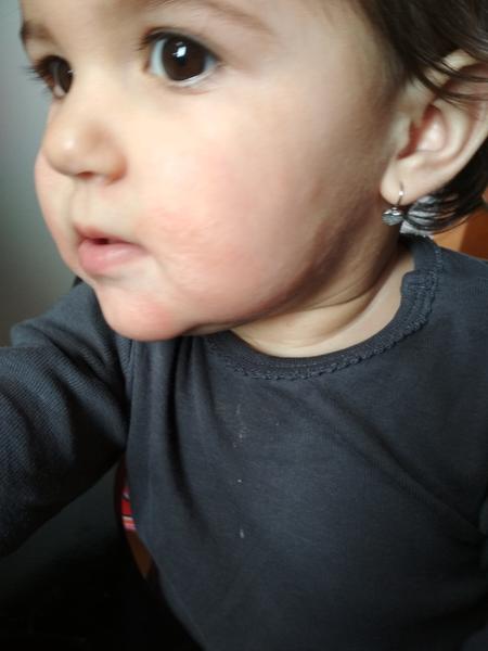 Trvající zarudnutí okolo úst u roční dcery. Prosím, poradíte?