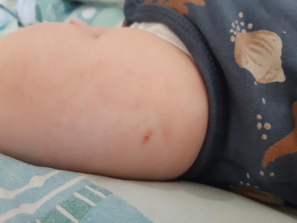 Flíček po očkování. Máte s tím zkušenost?